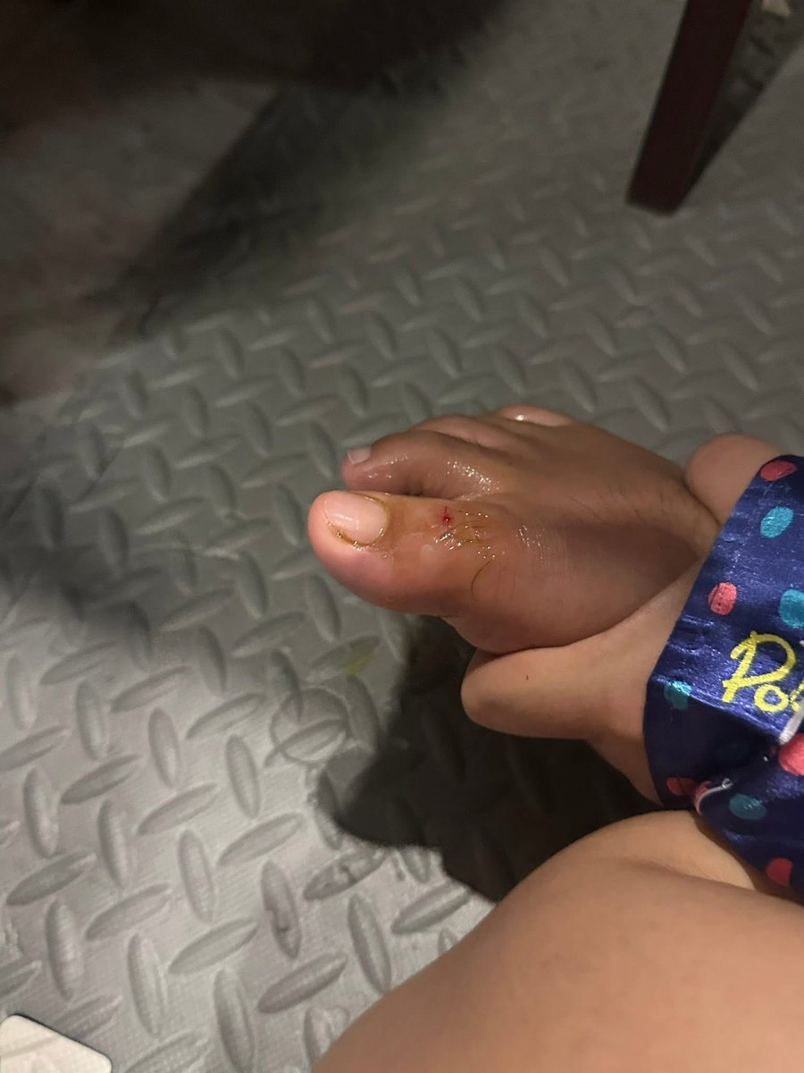 newroom44's tweet image. 🚨พี่สาวโดนงูกะปะกัดขา ตั้งแต่ตอนบ่าย2  อัปเดต 19.10 น. วันนี้  ขาเริ่มม่วงช้ำ เหมือนเกิดหนอง
น้ำเชี่ยวแรงออกไปไม่ได้ บ้านพี่อั้ม ห่างจาก อบต.แม่ทอม 1 กิโลเมตร โทร 091-845-9789 ไผ่ ไม่มีสัญญาณเน็ต  maps.app.goo.gl/iAPMN23QrtUxkV…

#น้ำท่วมหาดใหญ่ #หาดใหญ่ #ข่าววันนี้ #theroom44