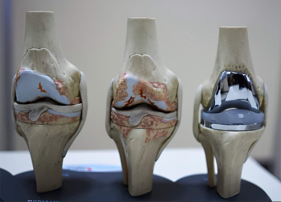 sherry_health's tweet image. You’ve tried everything for your arthritis — collagen, fish oil, stretching, painkillers…  

Yet your knees still ache.   

&amp;amp; every morning feels like your joints have rusted overnight.  

Here’s what no one tells you about arthritis 
— and the method that actually fixes it