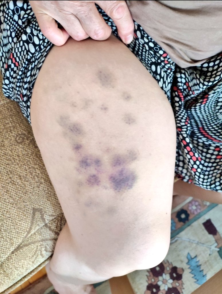 Sayın bakanım 65 evet 65 yaşındaki annem polise ihbar ettiği iddiası ile darp edildi. Kabacası dövüldü,tehdit edildi.

Mahkeme para cezası evet para cezası verdi sadece. Tehditten ise beraat. 

O saldırıdan sonra 8 kere daha saldırdı fail. 

Sıfır tutukluluk var. Yer DENİZLİ