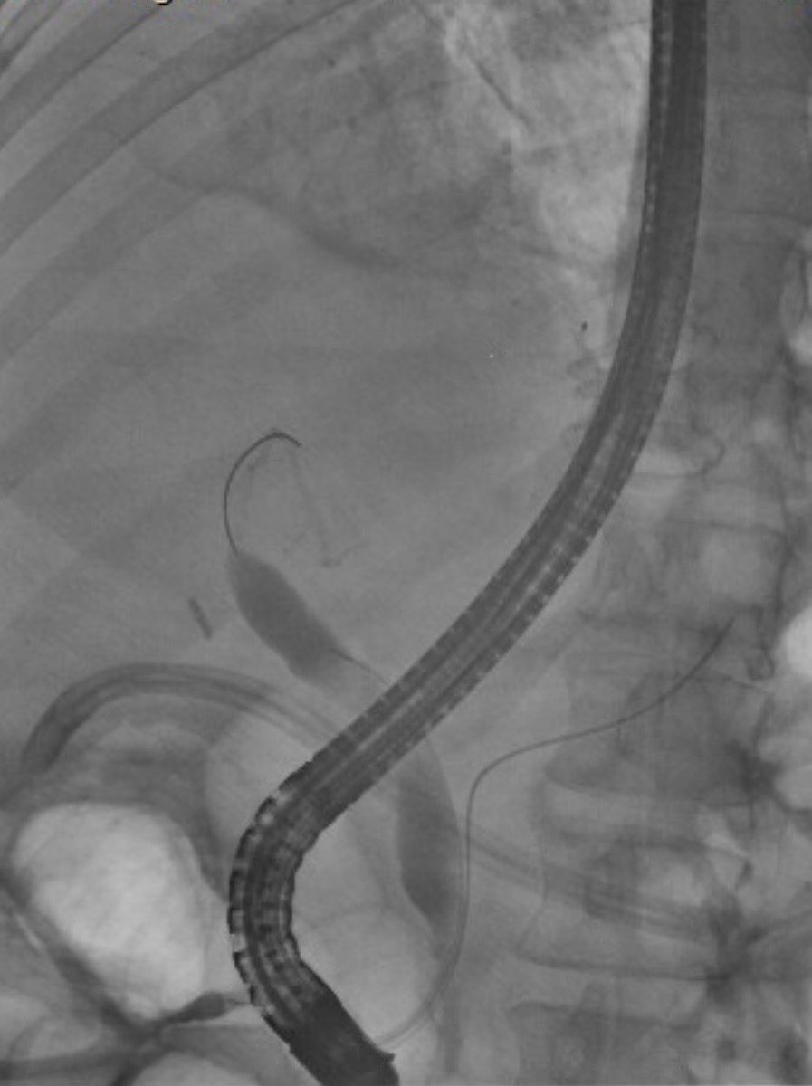 thayern's tweet image. One-stage EDGE performed for a RNY pt with symptomatic choledocholithiasis.
Transgastric access obtained w/ LAMS → stent fixation → ERCP with duct clearance.
A reliable option for RNY anatomy that avoids the long-limb ERCP challenges in altered anatomy. #GITwitter #ERCP #EUS