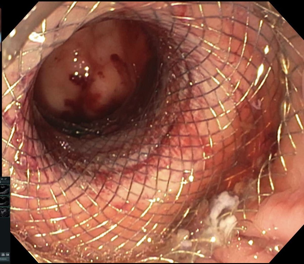 thayern's tweet image. One-stage EDGE performed for a RNY pt with symptomatic choledocholithiasis.
Transgastric access obtained w/ LAMS → stent fixation → ERCP with duct clearance.
A reliable option for RNY anatomy that avoids the long-limb ERCP challenges in altered anatomy. #GITwitter #ERCP #EUS