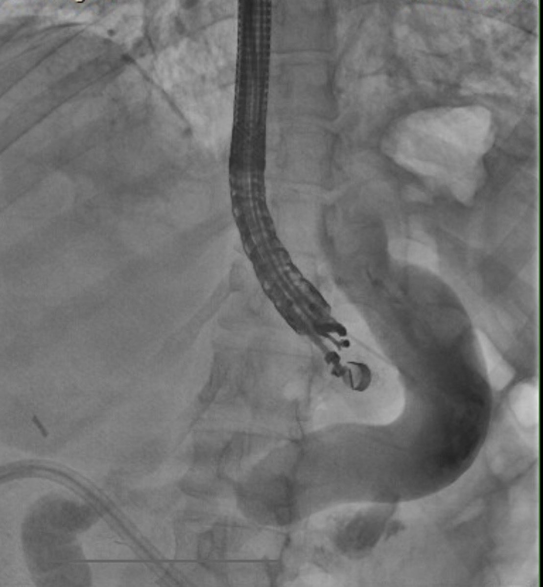 thayern's tweet image. One-stage EDGE performed for a RNY pt with symptomatic choledocholithiasis.
Transgastric access obtained w/ LAMS → stent fixation → ERCP with duct clearance.
A reliable option for RNY anatomy that avoids the long-limb ERCP challenges in altered anatomy. #GITwitter #ERCP #EUS
