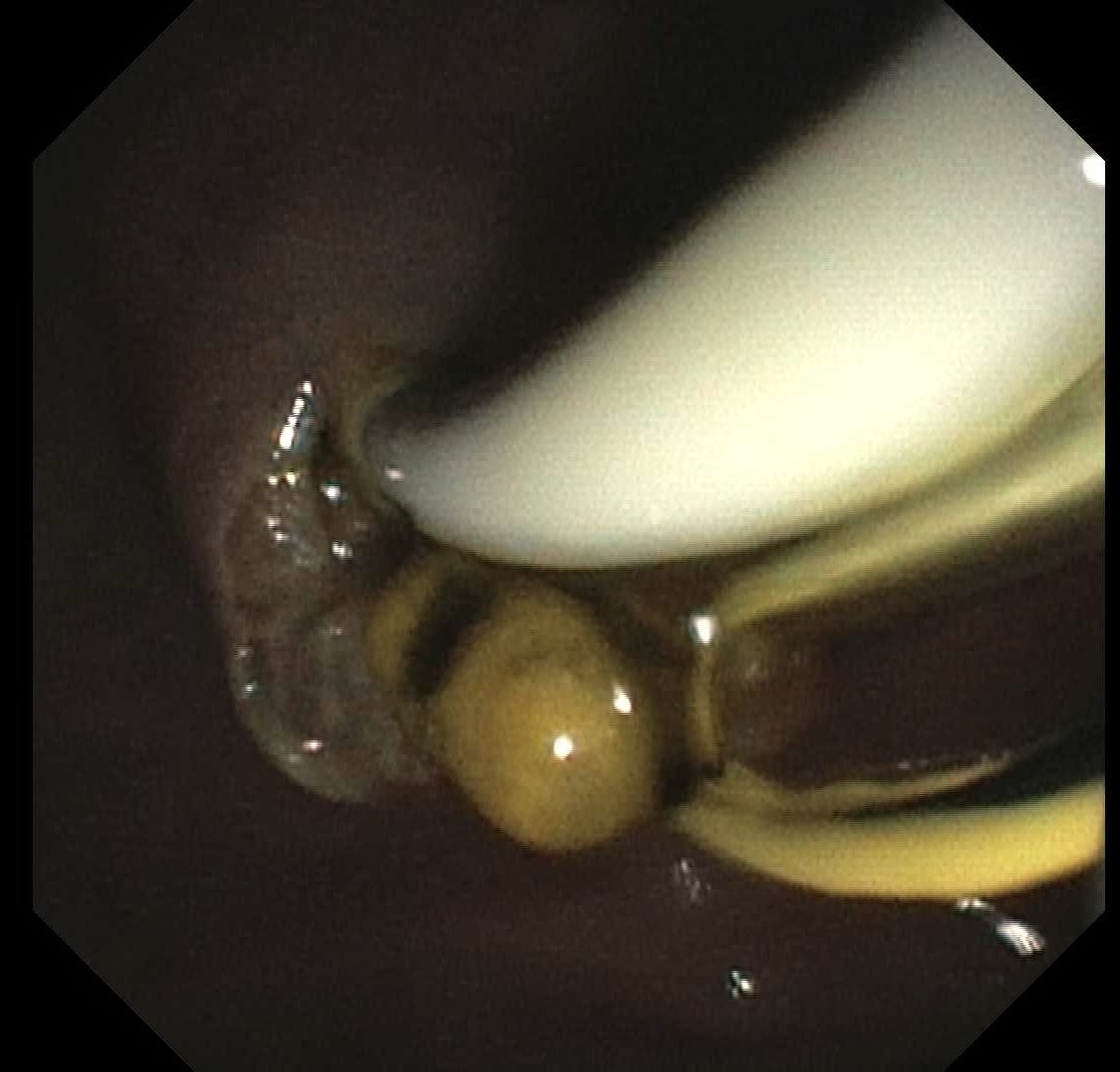 thayern's tweet image. One-stage EDGE performed for a RNY pt with symptomatic choledocholithiasis.
Transgastric access obtained w/ LAMS → stent fixation → ERCP with duct clearance.
A reliable option for RNY anatomy that avoids the long-limb ERCP challenges in altered anatomy. #GITwitter #ERCP #EUS