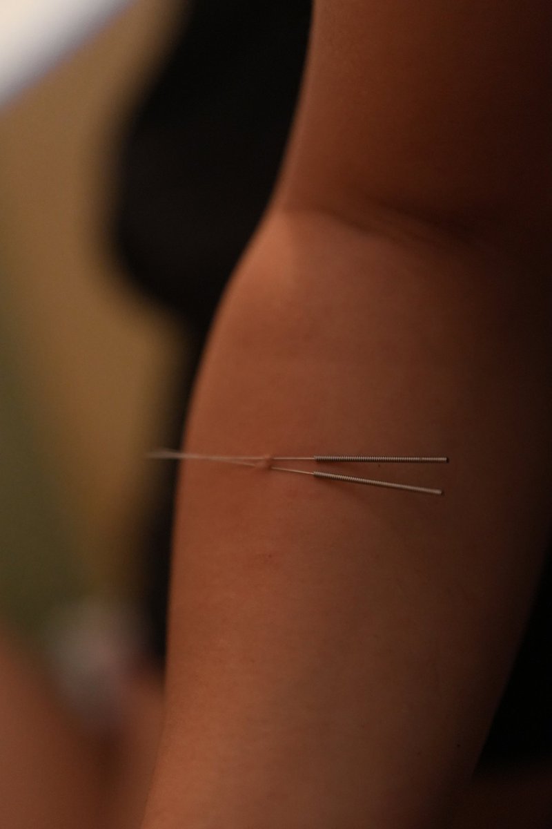 恐针患者穿刺初体验，全程闭眼猛抖
紧握着安生宝宝的手，针初进时如同打点滴般痛，感受针头顶着皮肤穿出去的恐惧，拔针时皮肤和针缓慢拉扯感又痛又怕，总结恐惧大于疼痛
穿刺： <a href="/wy_smxs/">WONGYOO</a> 
摄影: @lw7826810239143 
情绪价值提供者： <a href="/shera27593/">安生</a>
模特: <a href="/wuyuesky/">半半</a> 
场地: <a href="/TLtianlan/">天蓝</a>