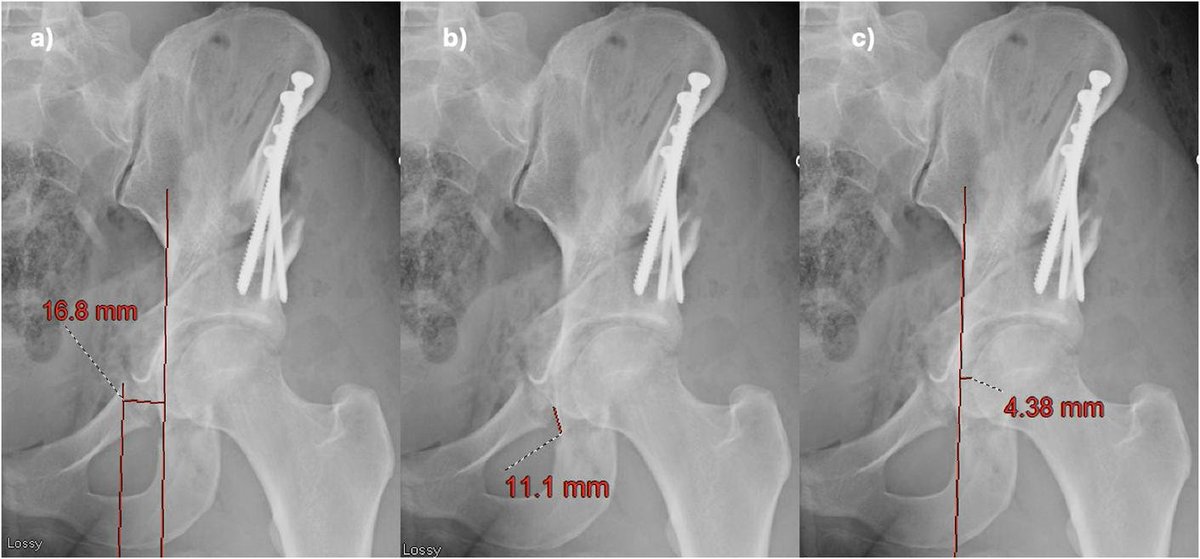 jbjs's tweet image. &quot;Risk Factors Associated With Nonunion Following Periacetabular Osteotomy for Treatment of Symptomatic Hip Dysplasia&quot; by Beyer et al.

Read online at: bit.ly/3JLFt2f