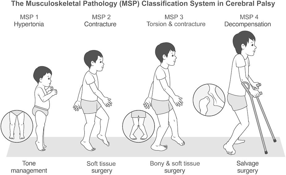 jbjs's tweet image. &quot;Epidemiology of Lower Limb Musculoskeletal Pathology in Cerebral Palsy&quot; by Korbal et al.

Read online at: bit.ly/49D2XkL