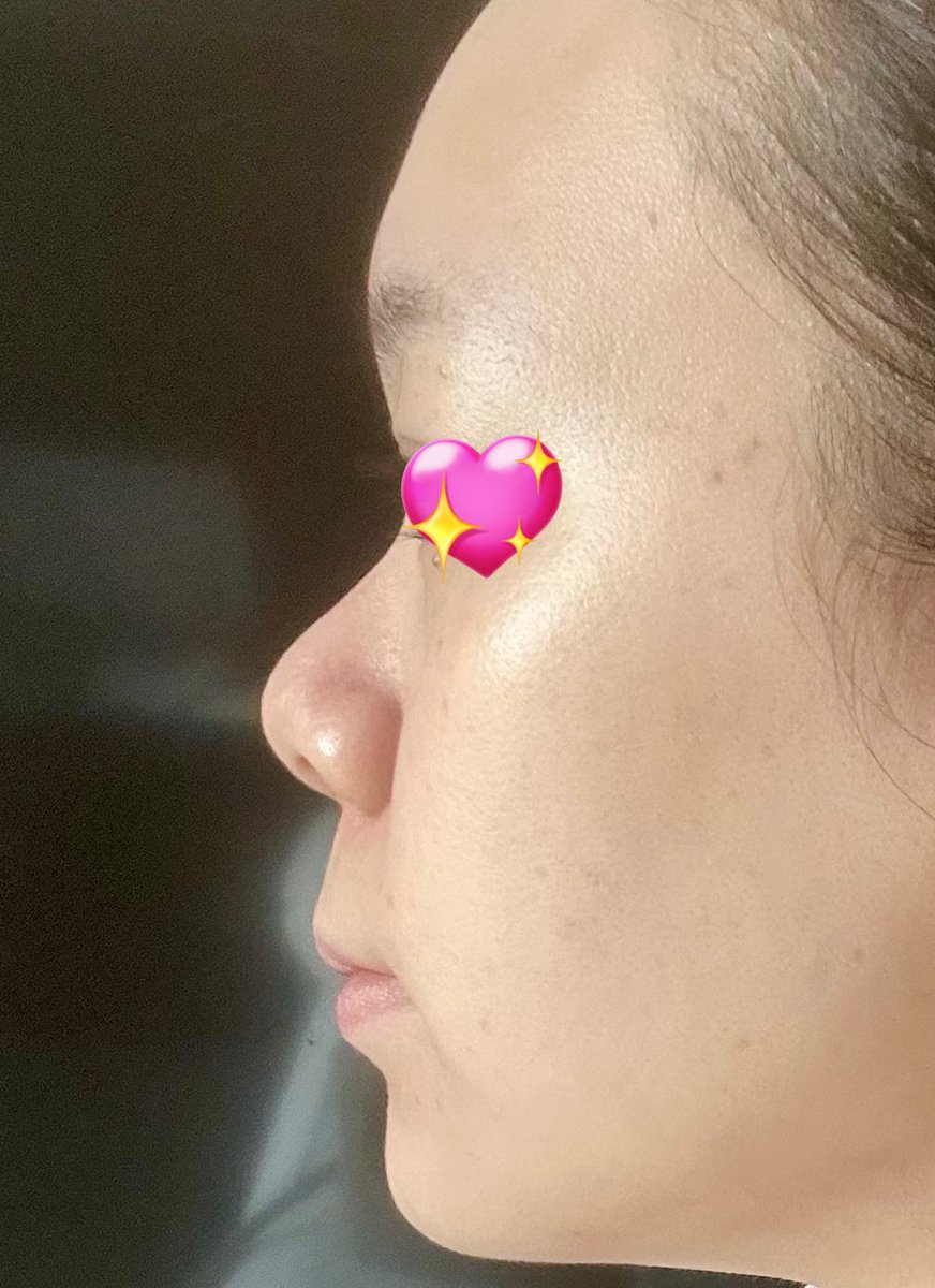 ncz4qs's tweet photo. 3ヶ月前まで左だったのが信じられないくらい綺麗😭前までギャンギャン加工してたのに今はノーマルの方が盛れるようになった✨️でま久しぶりに会う友達にもあんまり気が付かれない程度のナチュラルさ！
大満足だしやっとDT3ヶ月目で嬉しい
あとは人中と口周りのもたつきどうにかして顔完成👏 https://t.co/Ansu6Q3wo0