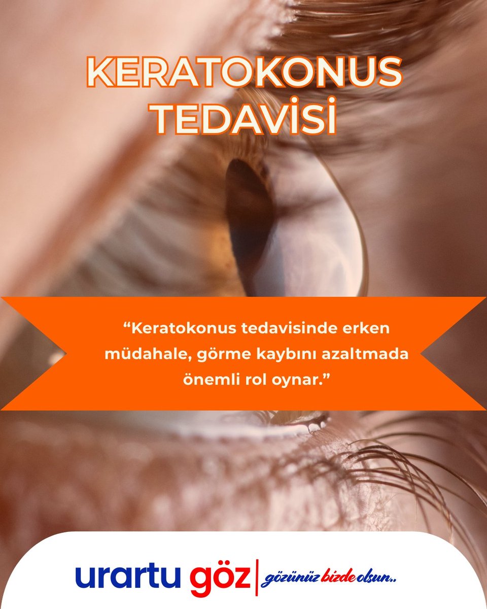 👁️ Keratokonus Nedir?

📌 Bu içerik yalnızca bilgilendirme amaçlıdır.
 detaylı değerlendirme için mutlaka göz hastalıkları uzmanına başvurunuz.

📍 Urartu Göz Merkezi
#keratokonus #kornea #gözhastalıkları #gözsağlığı #urartugöz #gözünüzbizdeolsun #bilgilendirme