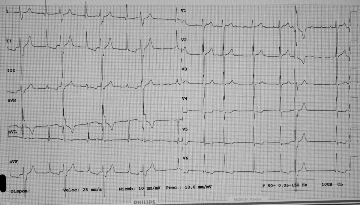 josecruz2102's tweet image. ✅Really interesting ECG from today✅

#Cardiology #ECG #rhythm #EPeeps 

🫀Opinions?  Rhythm, conduction…