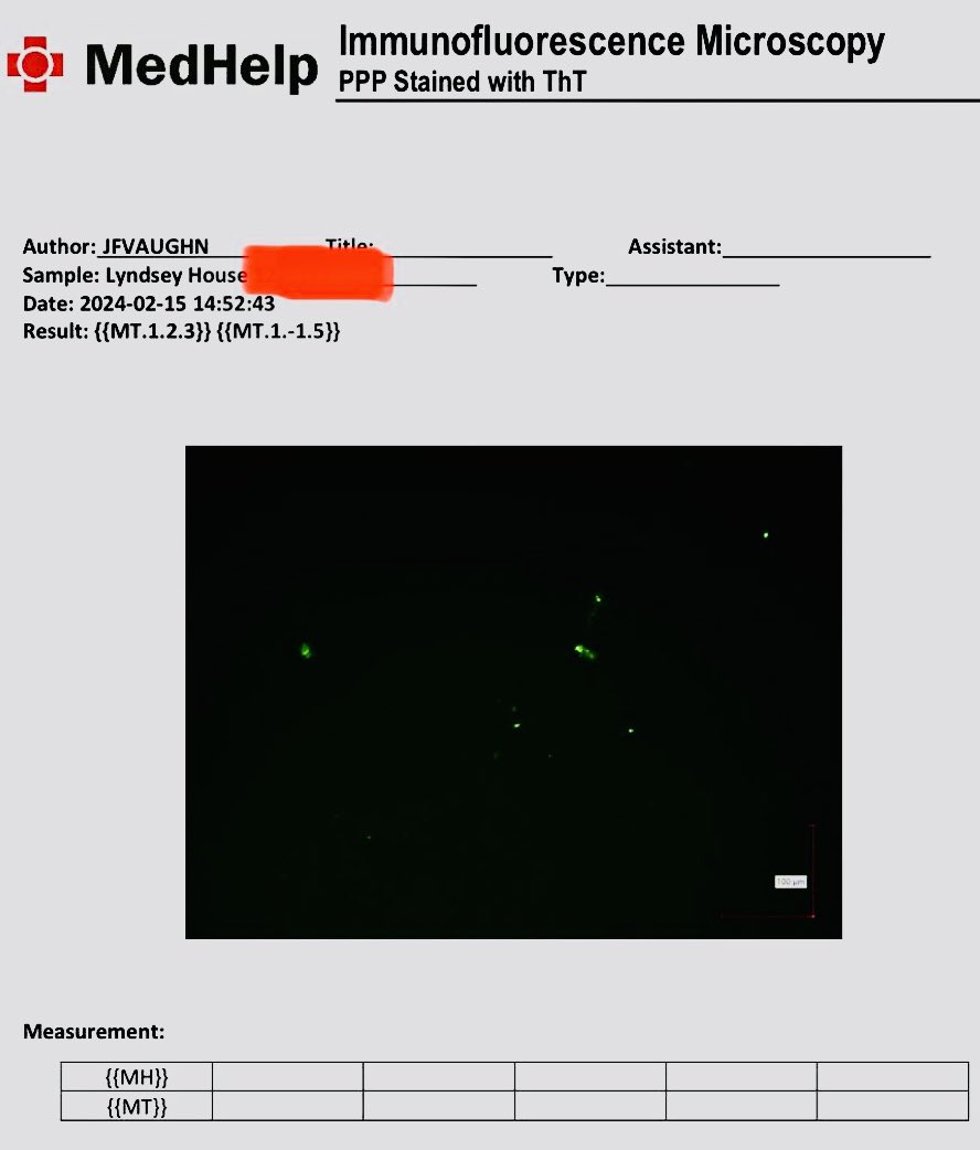HouseLyndseyRN's tweet image. Immunofluorescence Microscopy PPP stained with ThT

My Results featuring my Amyloid Fibrin Clots that @NicHulscher is covering below

If you are vaxed or have had long covid please pay attention and review 

~&amp;lt;3 nurse lynz