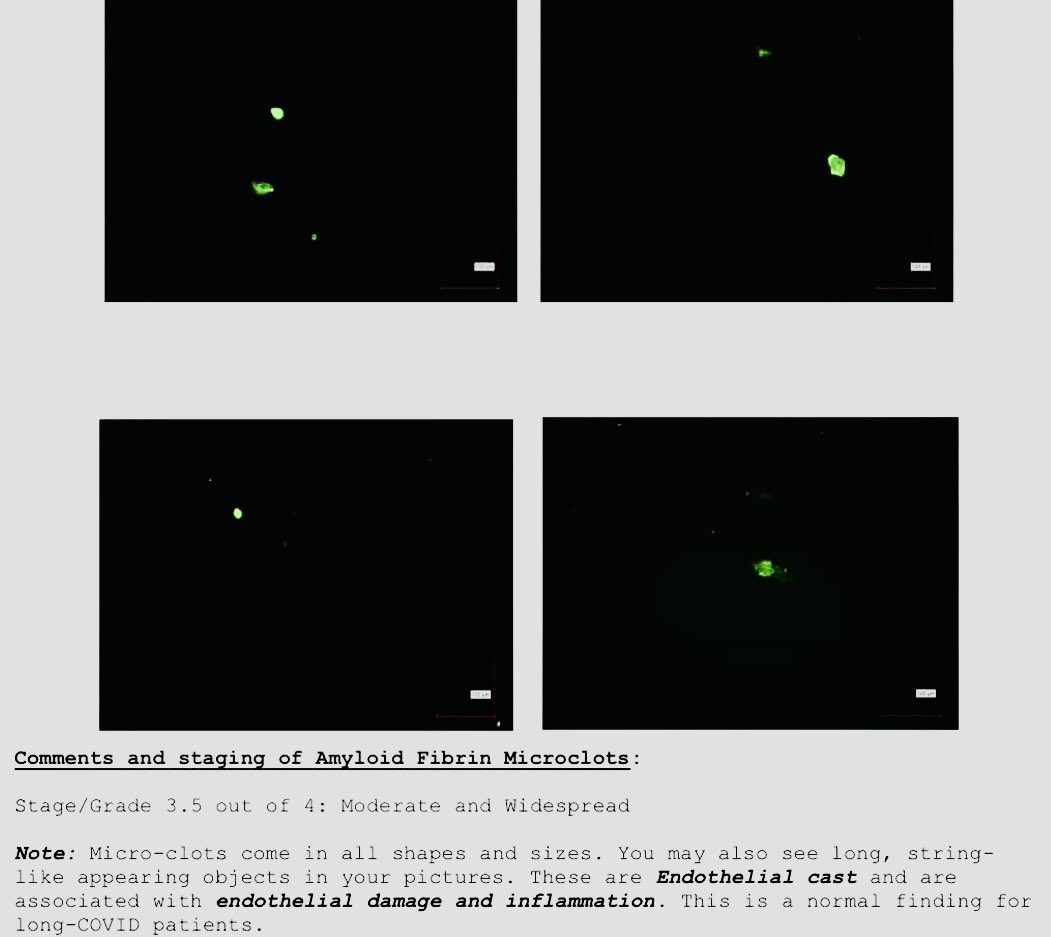 HouseLyndseyRN's tweet image. Immunofluorescence Microscopy PPP stained with ThT

My Results featuring my Amyloid Fibrin Clots that @NicHulscher is covering below

If you are vaxed or have had long covid please pay attention and review 

~&amp;lt;3 nurse lynz