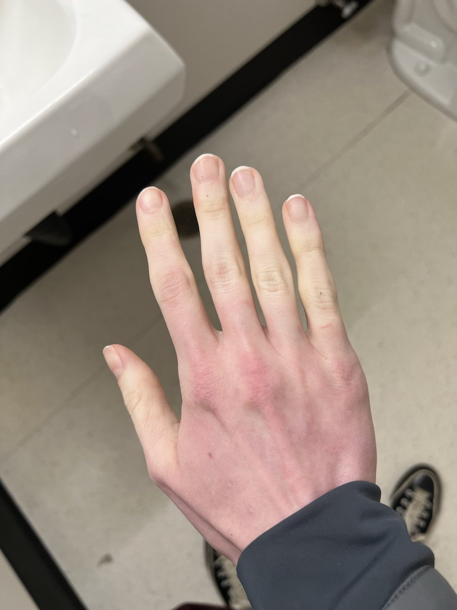 contextinspectr's tweet image. once again asking if anyone fw quirked up white girls with raynaud’s syndrome