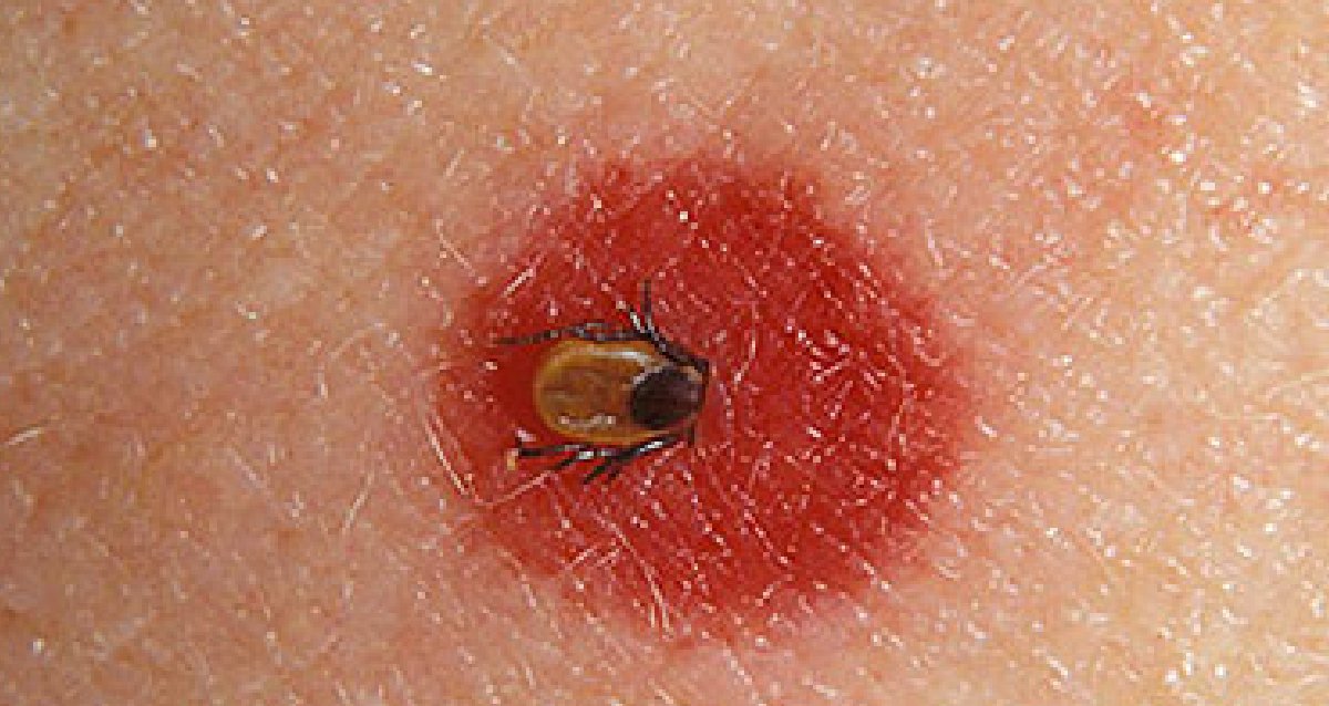 WebMD's tweet image. Ticks can dig into any part of your body, but they really like folds, creases, or hairy areas like your scalp. They can range from the size of a sesame seed to that of an apple seed or larger. wb.md/49ykM4g