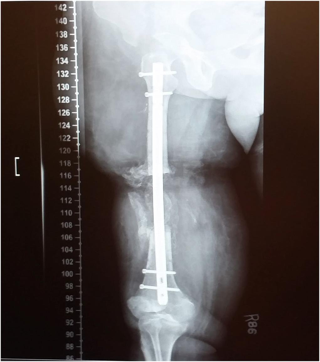 jbjs's tweet image. Introducing a new JBJS article type: Patient Voices

&quot;A Second Trauma: Navigating Infection After Orthopaedic Surgery&quot; by Marvel et al.

Read online at: bit.ly/48jNcNk