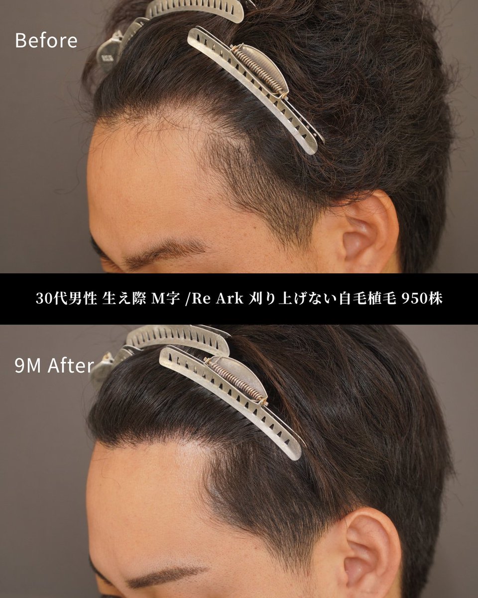 Re Ark 刈り上げない自毛植毛950株】 20代男性 M字、生え際 術後1年 当