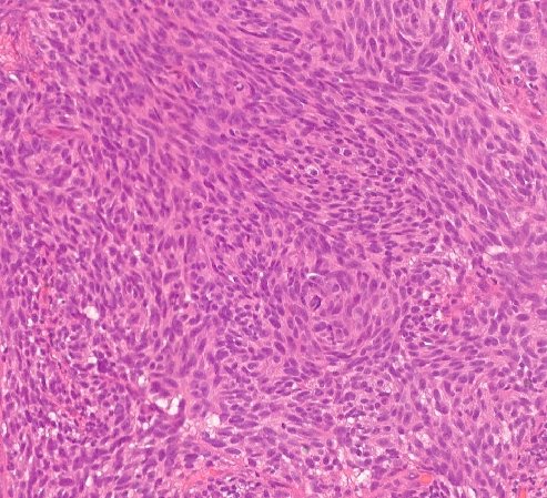The many faces of melanoma on FNA. This time, the cells are discohesive and spindled. Paired with histology from the biopsy.

#PathTwitter #MedTwitter #CytoPath #DermPath #PathResident