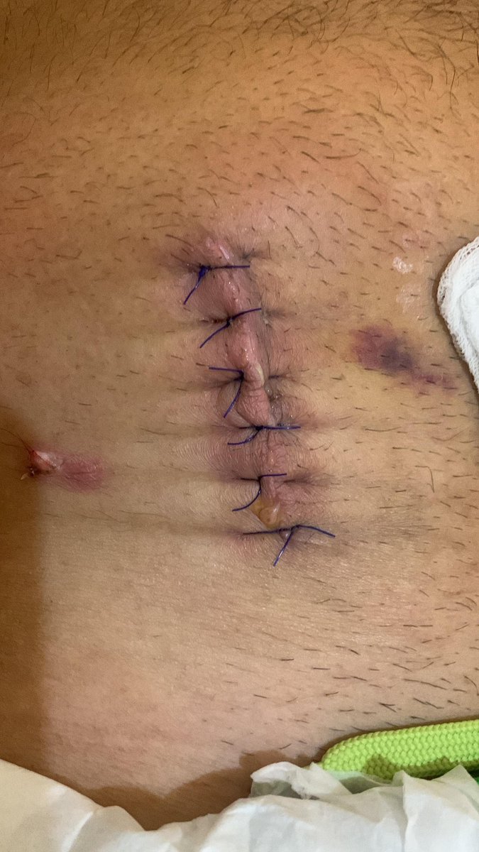 Teman-teman makasih atas doa² kalian yang tidak bisa kusebut satu-persatu Namanya, kini aku sudah keluar dari RSUD CILEGON dan sekarang tinggal masa pemulihan luka  pasca operasi Usus Buntu seminggu lalu.

Tetap semangat dan tetap teguh untuk bersuara lantang memperjuangkan