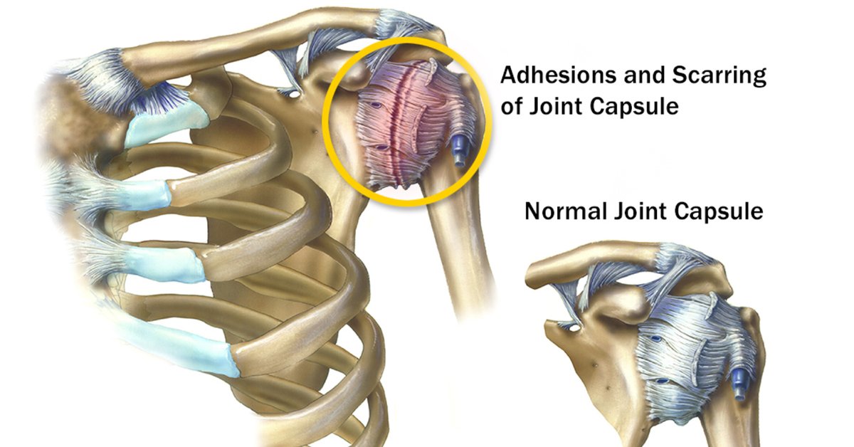 WebMD's tweet image. Frozen shoulder causes the shoulder capsule to get thicker in parts and inflamed. This may limit the “synovial” fluid that normally lubricates the area and prevents rubbing. The result: pain and stiffness. Learn more: wb.md/3Kd4Gmc