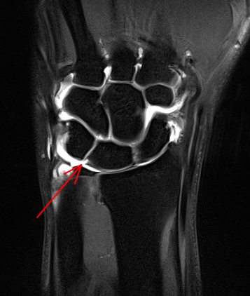 themskarchive's tweet image. 26/11/2025.🖐️37M with central dorsal wrist pain.
US-guided arthrography showed immediate contrast passage from RC into the MC joint → intrinsic ligament tear.
📸 CT &amp;amp; MR arthrograms confirmed complete lunotriquetral ligament rupture

#MSK #Radiology #SLIL #WristPain #MRI #CT🩻