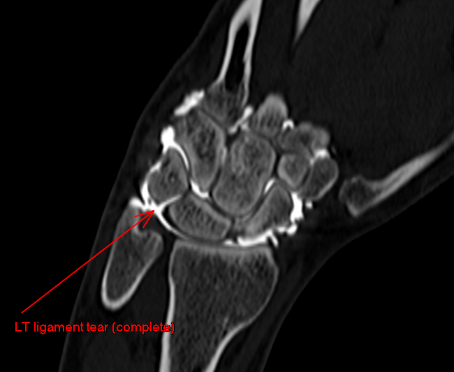 themskarchive's tweet image. 26/11/2025.🖐️37M with central dorsal wrist pain.
US-guided arthrography showed immediate contrast passage from RC into the MC joint → intrinsic ligament tear.
📸 CT &amp;amp; MR arthrograms confirmed complete lunotriquetral ligament rupture

#MSK #Radiology #SLIL #WristPain #MRI #CT🩻