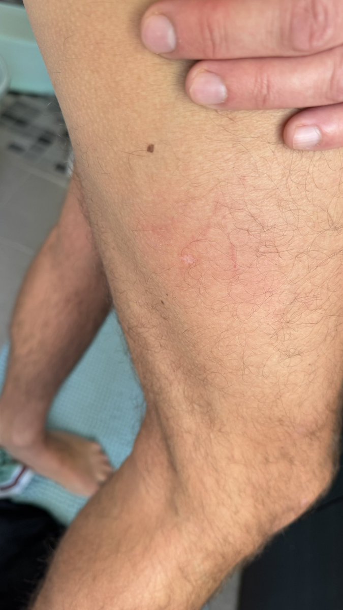 Hui, fast zu Hause und zack mit dem Rad  hingelegt. Wege sind spiegelglatt, bin seitlich runter, sogar mit dem Kopf aufgeschlagen. Lag unter dem Rad, bis mich eine Frau hochgezogen hat.
Der Oberschenkel färbt sich gerade und tut höllisch weh. Perfekter Start in den Tag. 🙃