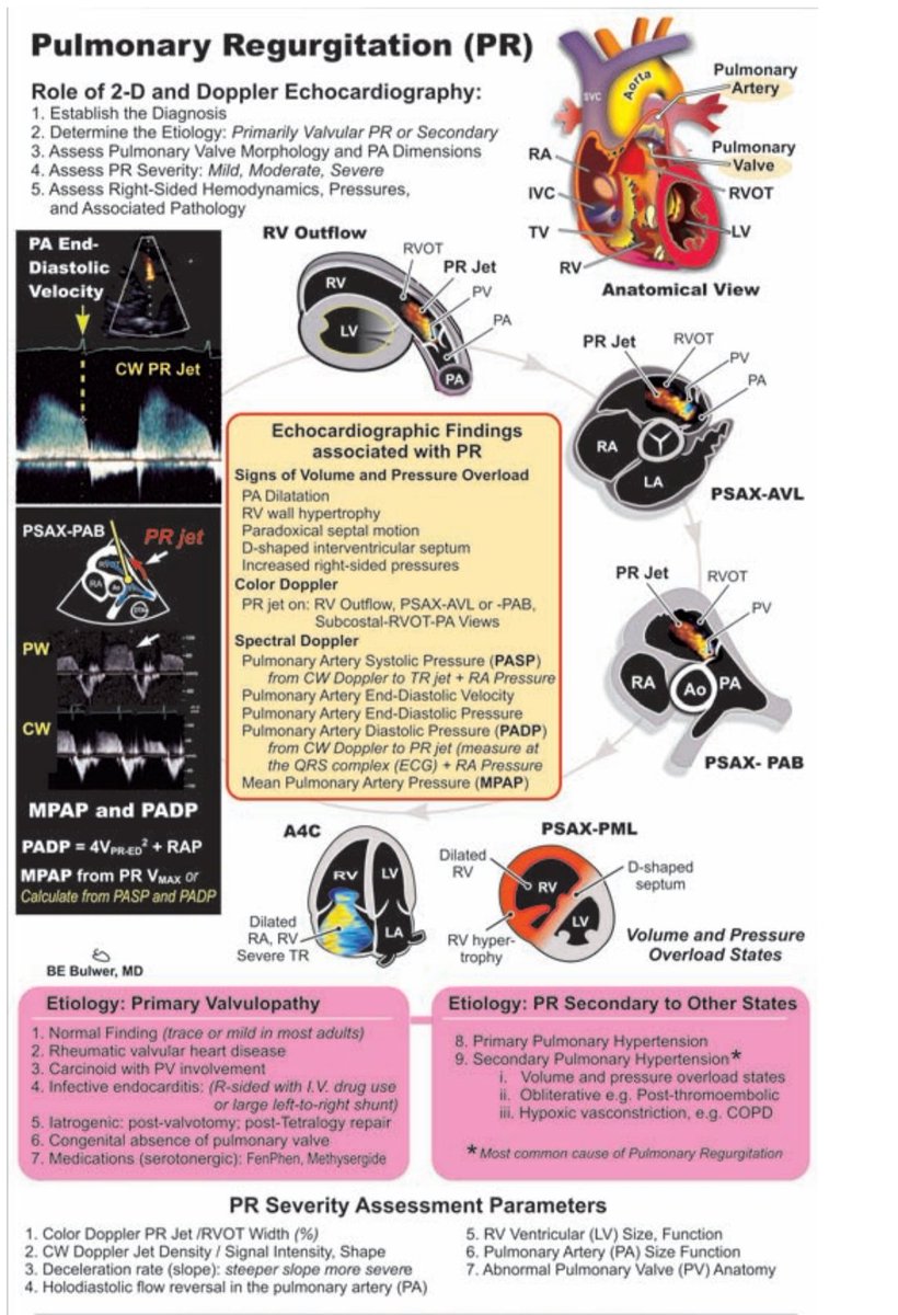 Echocardiographic assessment of pulmonary regurgitation