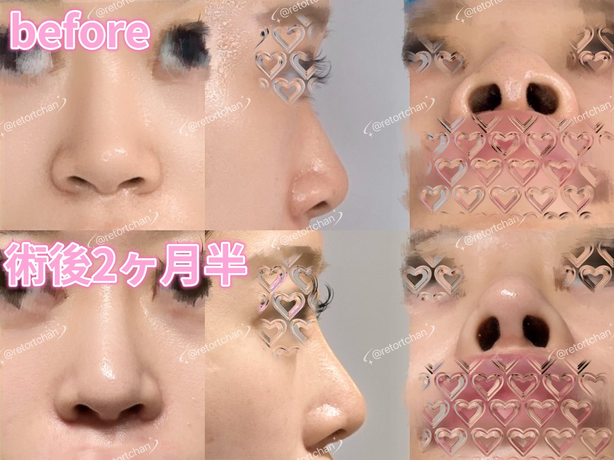 retortchan's tweet photo. LUHO美容外科で鼻手術・目の下脂肪再配置から3ヶ月弱経ったのでビフォアフ載せます！
なるべく同じ角度で撮りました🥹🌟

beforeは鼻の穴が丸くて本当にコンプレックスでした😭💦
私みたいな悩んでる方の参考になれば幸いです！
#ルホ整形外科 #LUHO美容外科 #鼻整形 #整形垢さんと繋がりたい https://t.co/7RNTpPReGN