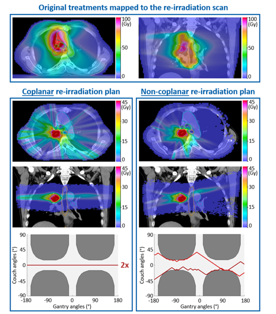 jonas_willmann's tweet image. Re-irradiating recurrent NSCLC is challenging due to high cumulative OAR dose. Our automated non-coplanar planning approach reduces critical exposure while maintaining coverage ➜ safer thoracic re-RT 🔄🎯

doi.org/10.1016/j.phro…

@RadOncUSZ @Unispital_USZ #radonc