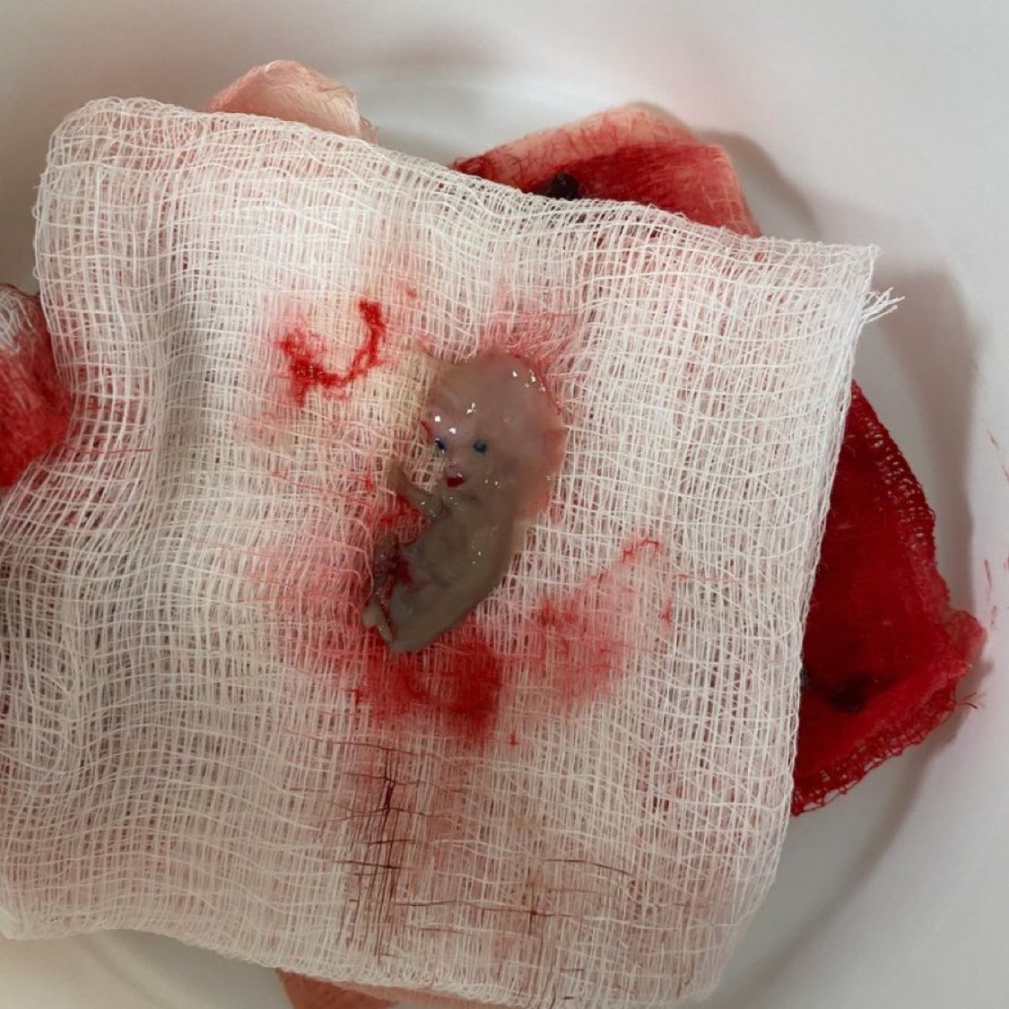 DepressedPrsn's tweet image. This is the extraction of a 9-week-old fetus from an ectopic pregnancy. 💀
Well it looks scary 🤯