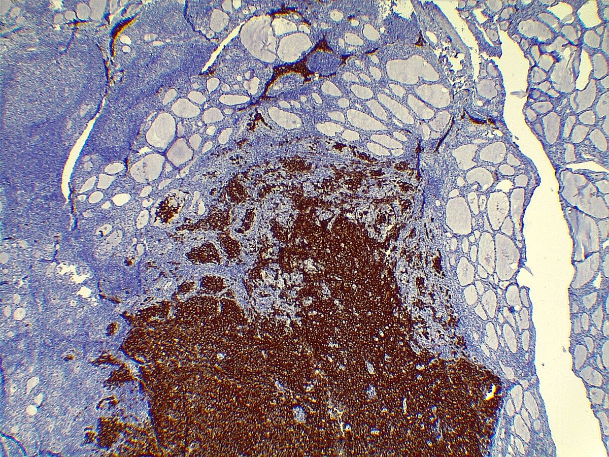 Previous thyroid case: multifocal PTC, classical and Warthin-like, the left lobe nodule is Langerhans cell histiocytosis, it can be mistaken for solid subtype PTC as both contains nuclear grooves, key point is eosinophils and prominent nucleoli. IHC is CD1a
#PathX