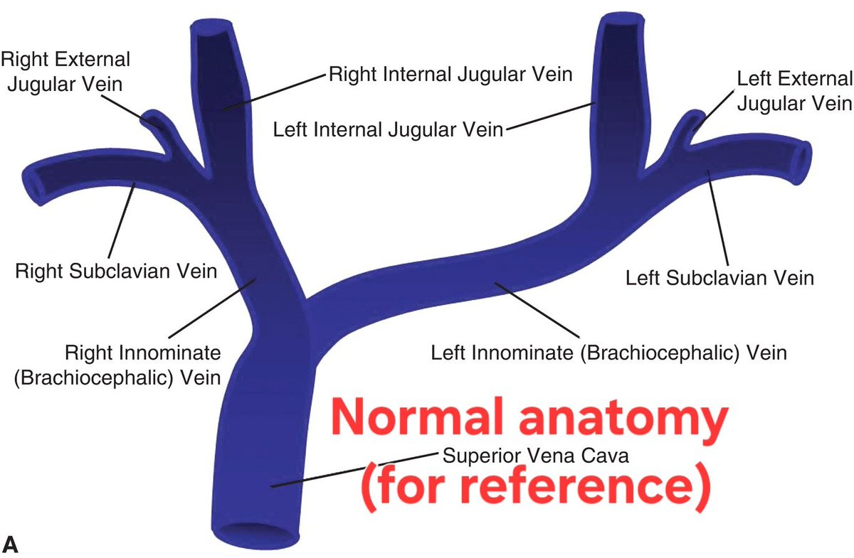 PocusPH's tweet photo. Sharing an interesting case I encountered today—one that may actually be worthy of a formal case report.

A 26-year-old female underwent insertion of a tunneled left internal jugular hemodialysis catheter (Permcath). The left side was chosen because the right IJ was no longer patent from multiple prior cannulations.

The procedure itself was uneventful. Ultrasound guidance confirmed that I had cannulated the left internal jugular vein properly, and the catheter advanced smoothly without resistance.

However, the post-procedure chest X-ray gave me an immediate scare. The catheter appeared malpositioned, raising concern for a serious complication. To clarify the anatomy, we requested a CT angiography—which fortunately brought relief.

The patient turned out to have a congenital anomaly: a duplicated, left-sided superior vena cava (persistent left SVC).

A rare but important anatomical variant that explained the unusual catheter trajectory on X-ray.

#InterventionalNephrology