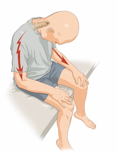 DrAkhilX's tweet image. Patient of multiple sclerosis.

What is this sign❓️