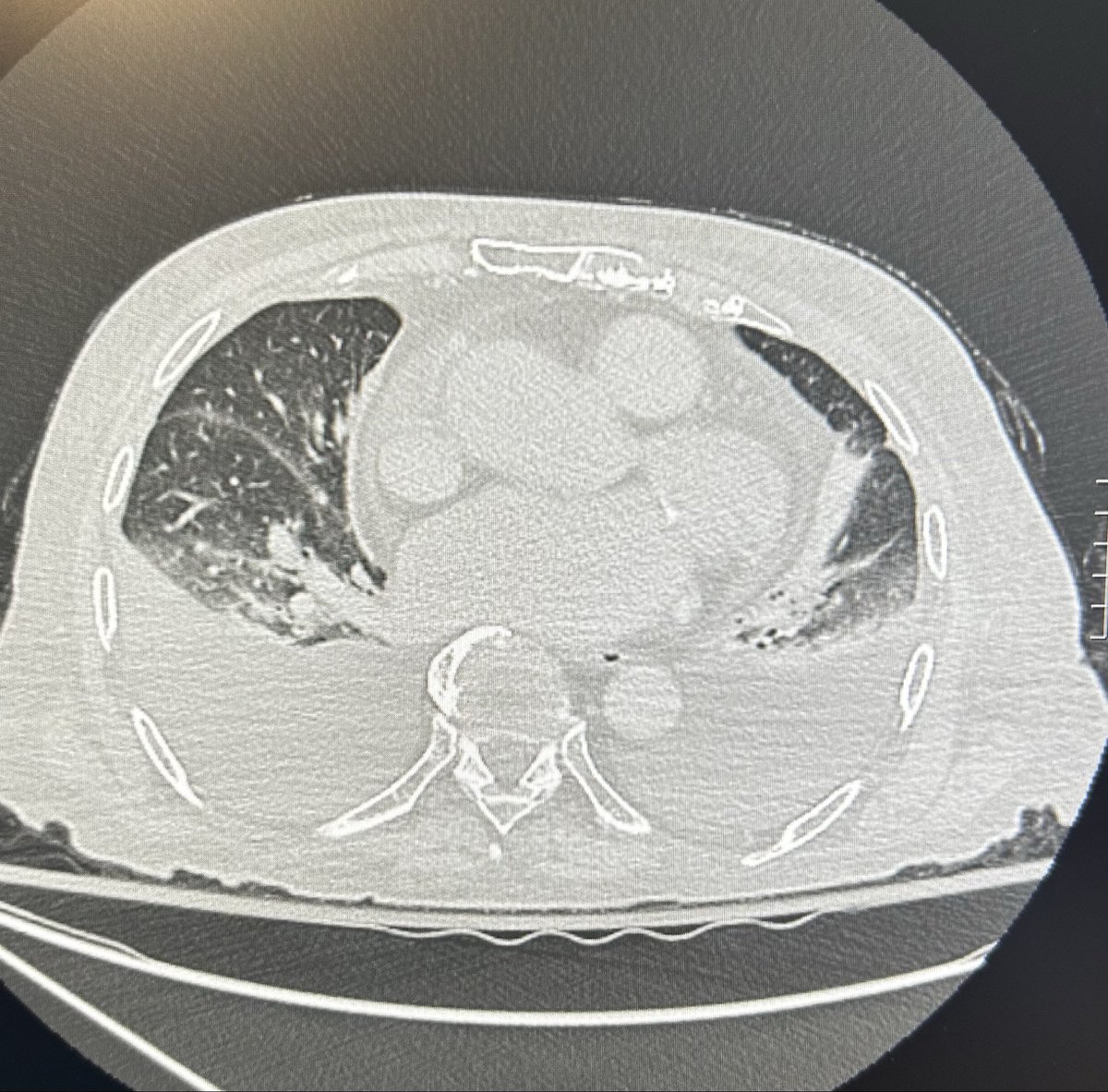 “Paciente desidratado”

PAREM de examinar mucosa de paciente crítico pra avaliar volemia / “hidratação” (e justificar sua vontade de dar água com sal na veia). É #cringe demais galera.