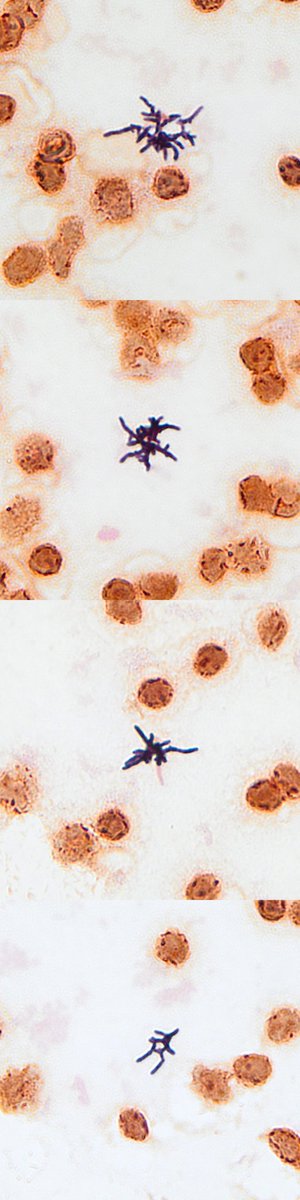 🔬Classic Gram stain morphology🔬

🕷️Spidery gram-positive bacilli🕷️

Cutibacterium (Propionibacterium) acnes

📸 Pictured is a blood 🩸culture 🧫 that was contaminated with these bacteria from the skin. It can cause infection; C. acnes is a common cause of shoulder PJI.