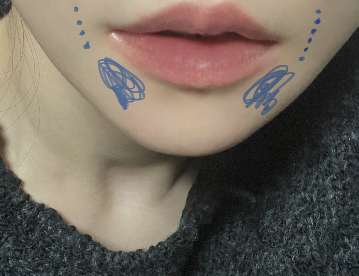 kanokano258055's tweet image. コケてきて暗く影になっちゃってた青いところにバイオスカルプチャー1本入れてもらってきた！点々のところは笑った時にできる笑い皺にも薄ーく！すごく若返った..🥹 口角下の顎コケは老けて見えるから注意⚠️バイオスカルプチャーだから組織のように馴染んできて口周りに最適！👩‍⚕️@33_m_91