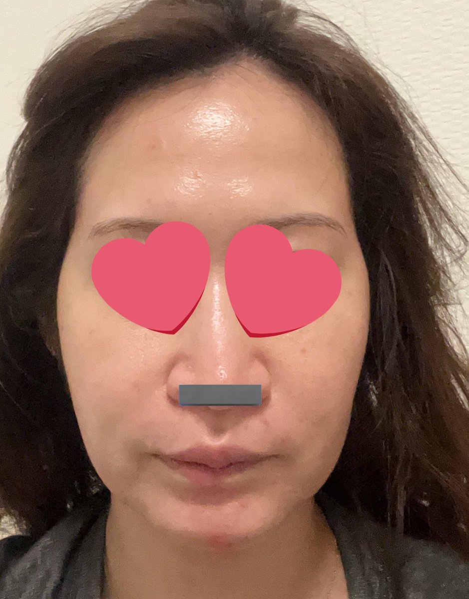yra1351's tweet photo. 髪ボサすぎるけど
dt４ヶ月と2週間と1日目

術前より+5.6kg太ってよくわからん https://t.co/v8y9qSj2ZE
