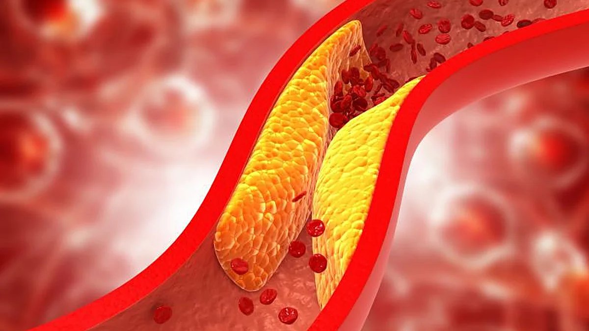 #46SEMI Los médicos internistas avisan: este tipo de #colesterol menos conocido pero más nocivo puede causar infartos, ictus y la muerte
👉Recomiendan medirlo al menos una vez en la vida para conocer si se tienen niveles de riesgo bajo, medio o alto.
abc.es/salud/enfermed… en