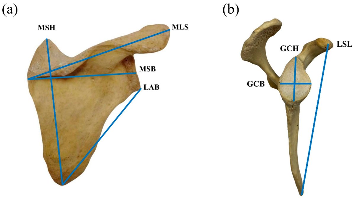 ForensicSciMDPI's tweet image. 🔔New article published!
&quot;Sex and Stature Estimation from Scapular Measurements: Development and Independent Validation in Northeastern Thai Population&quot;
✍️by Suthat Duangchit et al. 

#ForeniscSciences #OpenAccess 
Read the full paper here: mdpi.com/2673-6756/5/4/…