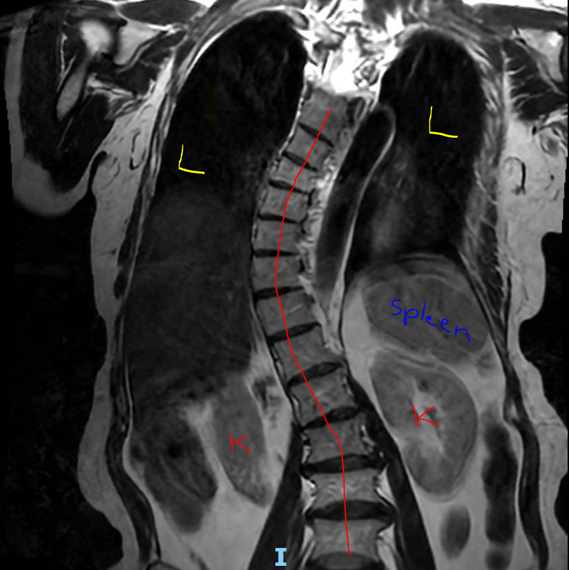 whitfieldlewis6's tweet image. I traced the vertebral column in red 🔴, and you can clearly see an S-shaped curve. When viewed in the coronal plane, this lateral deviation is called scoliosis. In more pronounced cases, surgical correction may be needed to straighten the spine and relieve symptoms such as back…