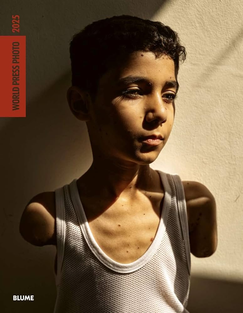 Esta es la foto ganadora del World Press Photo 2025. Un niño que perdió sus brazos a raíz de un ataque en Gaza. Cuando se dió cuenta, narran que lo primero que le preguntó a su madre fue: ¿Y ahora cómo te podré abrazar?.
No. No debe haber Eurovisión sin derechos humanos.