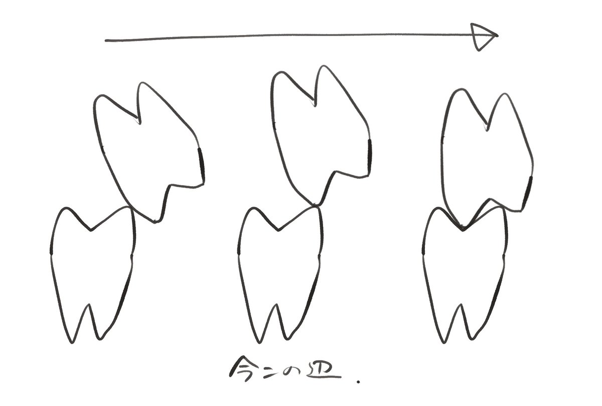 そっぽ向いた奥歯の矯正
口が閉じづらくなってきた…