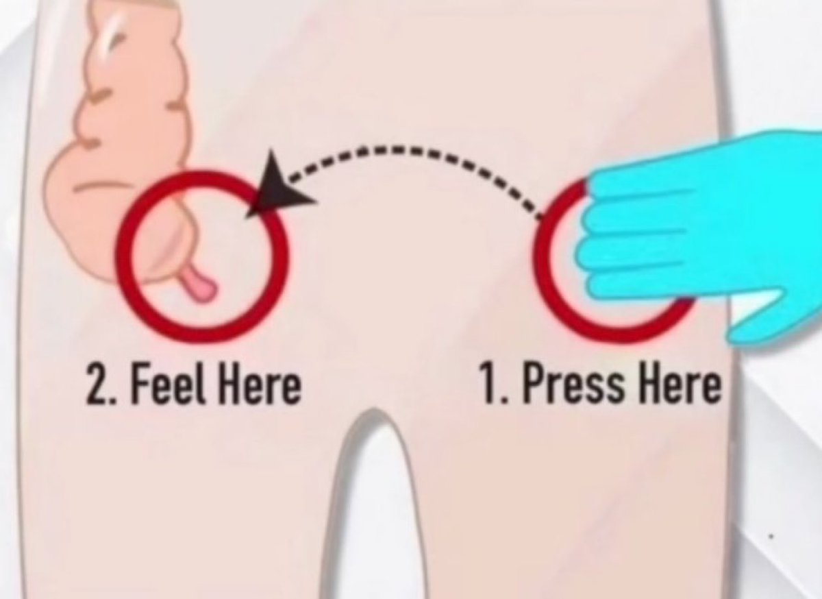 Identify this sign.

A. McBurney's sign
B. Rovsing's sign
C. Psoas sign
D. Obturator sign