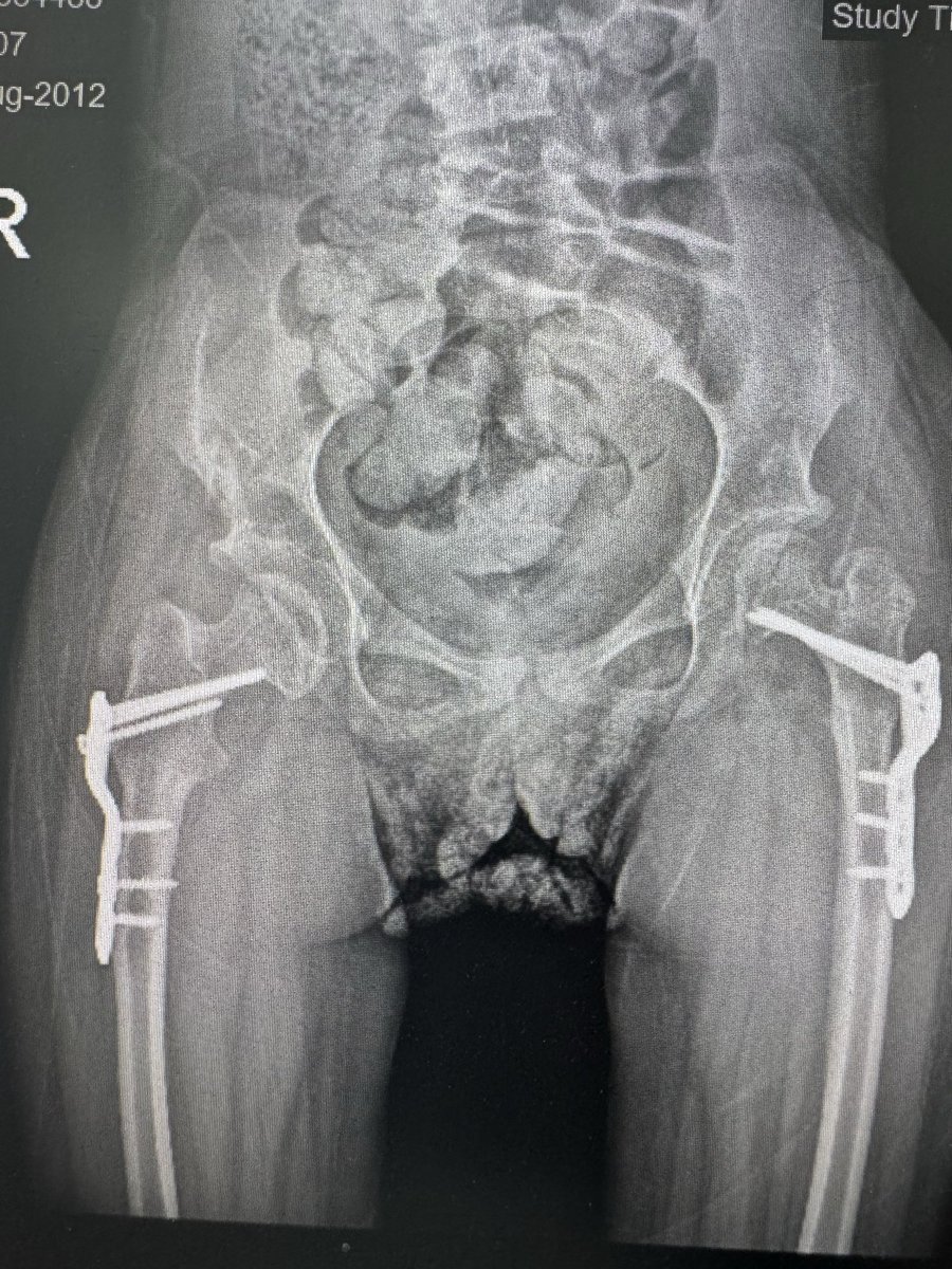 د. نبيل العساف، إستشاري جراحة عظام وعمود فقري tweet media