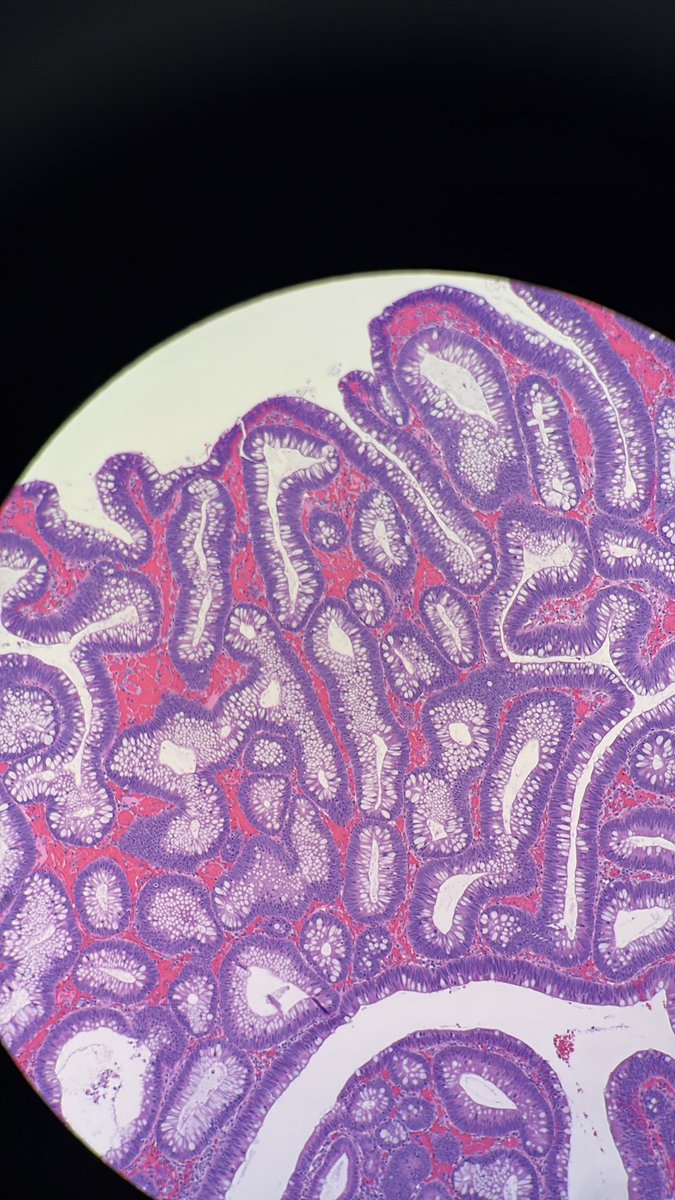 PathServerUS's tweet image. Starting the day with some Tubular Adenoma 🔬