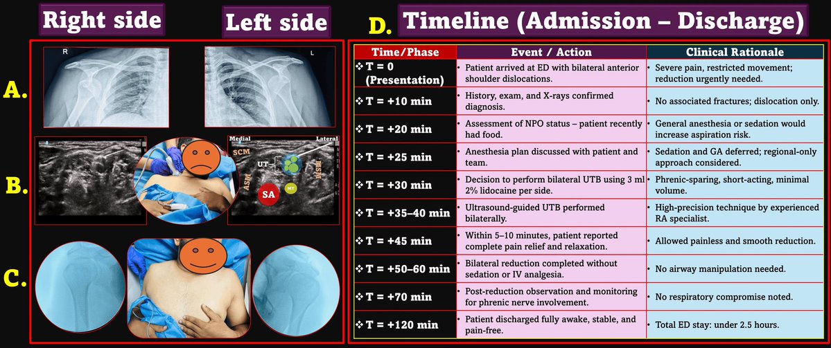 KartikBSonawane's tweet image. 🩺 How I Did It: Single-Stage Bilateral Shoulder Reduction Without Sedation or GA 💪

#HowIDidIt #UpperTrunkBlock
#BilateralBlock #PhrenicSparing
#SedationFree #AirwaySafe
#PrecisionRA #RegionalInED
#FastTrackRA #EDAnesthesia
#TipOfTheDay #MyRATips

Tip of the Day:

👨‍⚕️ A young…