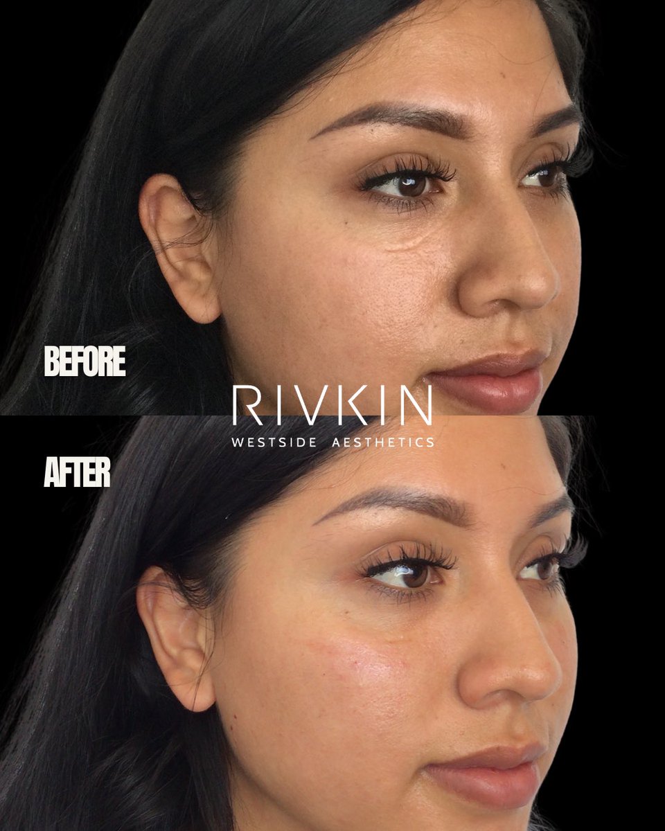Cheek filler is one of my favorite ways to restore harmony in the midface. 💉 When volume naturally decreases with age or weight changes, the cheeks can begin to look flat, tired, or less defined. we can bring back structure, lift, and light to the face.