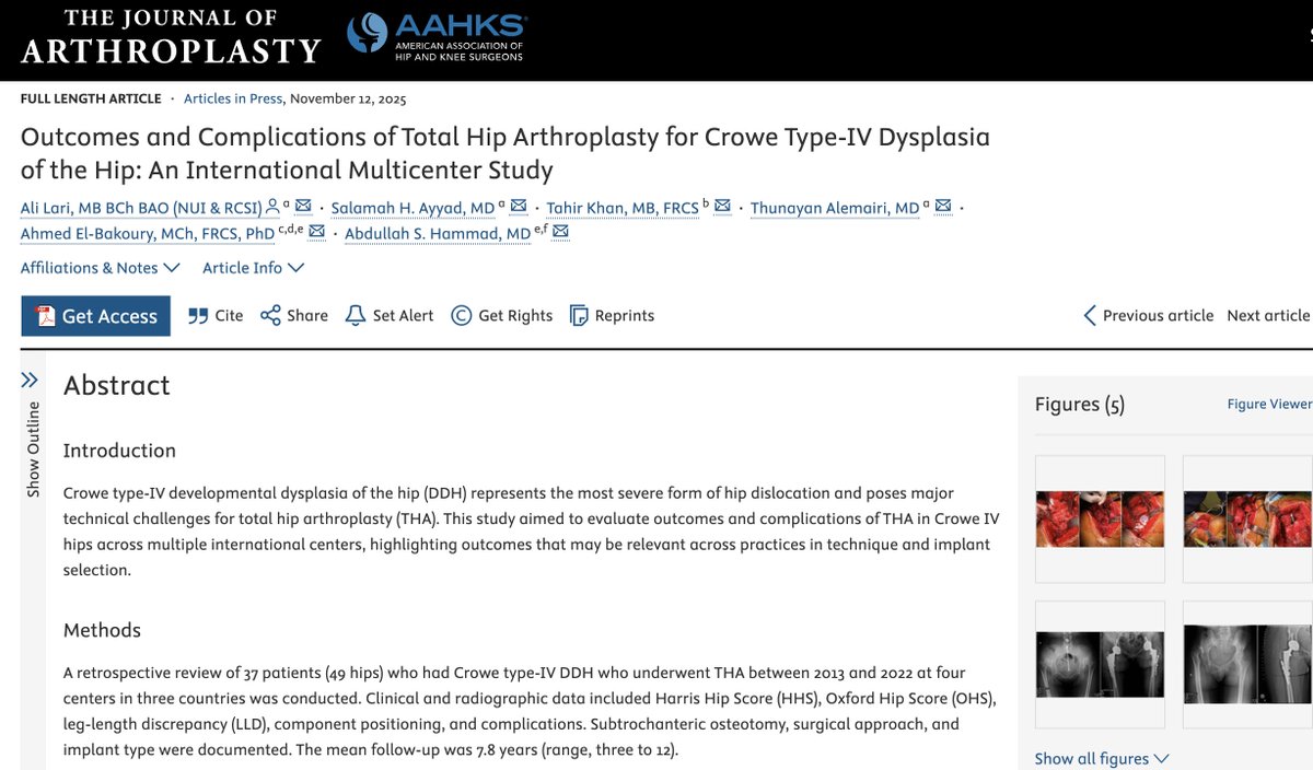 jervisyaumd's tweet image. Total hip replacement in Crowe IV hips is complex. A new multi-center study evaluates outcomes &amp;amp; complications, offering insights into surgical technique and implant selection that can guide practices worldwide. medilink.us/pkxt #HipReplacement #Orthopedics #Orthotwitter