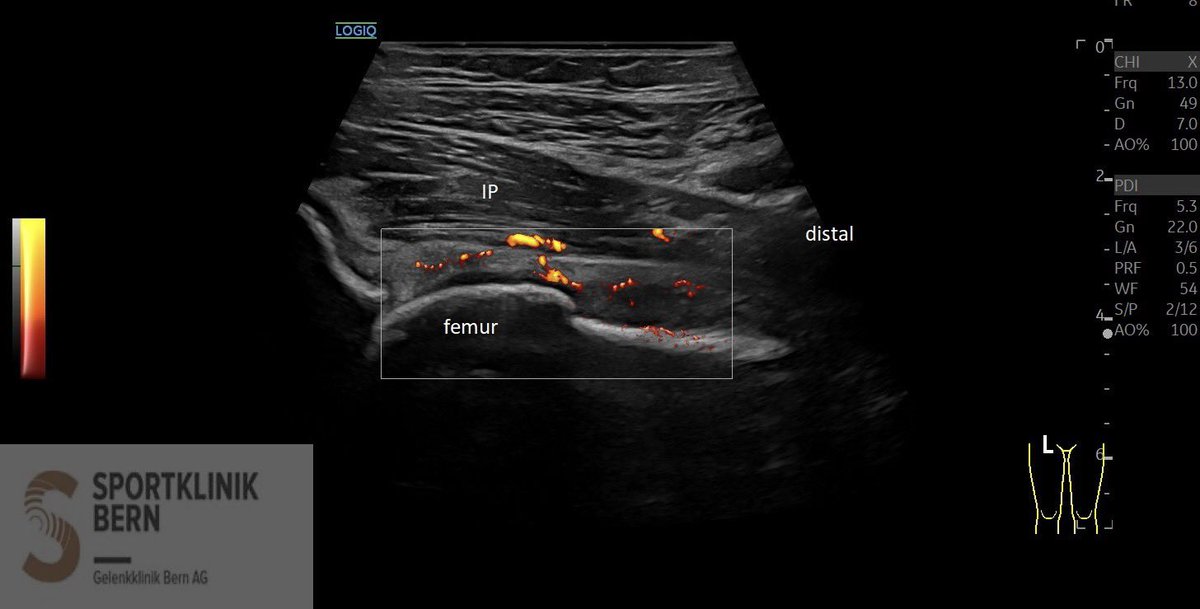 SportklinikBern's tweet photo. #Ultrasoundguidedinjection with #arthrexprp and #ostenilplus for hiparthrosis - mskus pocus pocushub GElogiqE10sr4 https://t.co/rW8PX1yuau