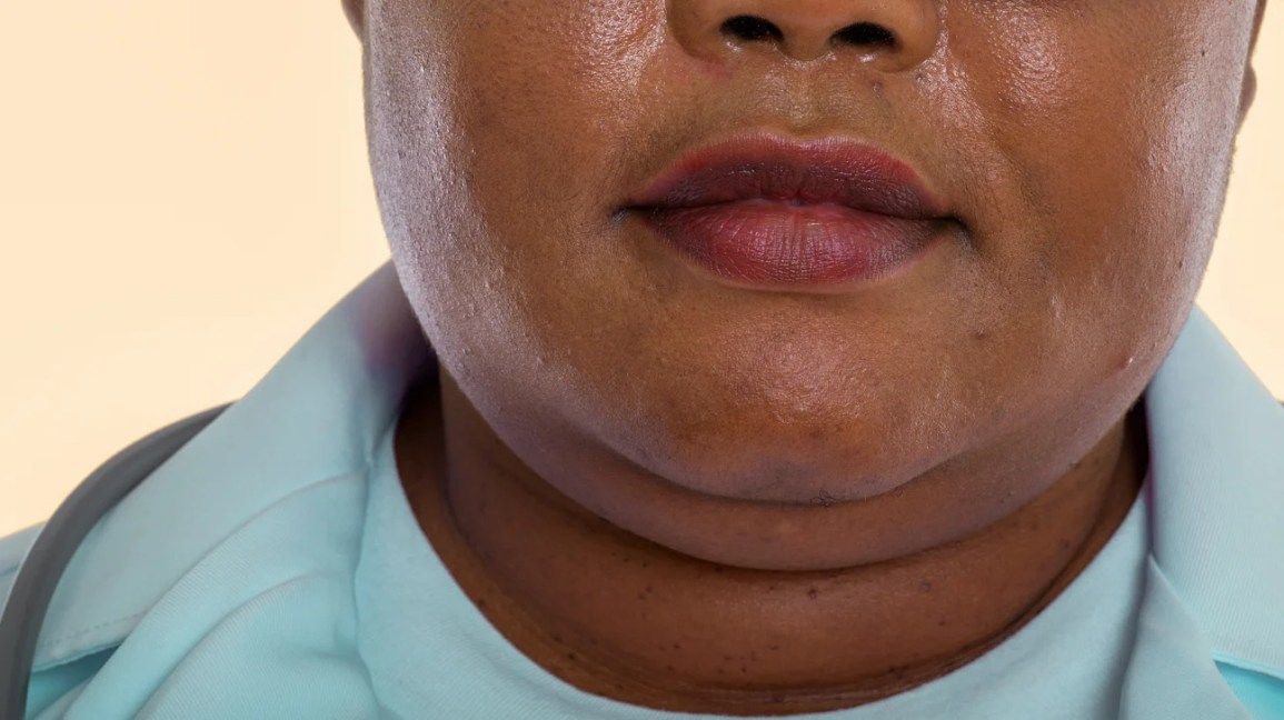amerix's tweet photo. A FAT NECK is a sign of insulin resistance.

Some of the problems associated with this fat neck are:

- Pre-diabetes

- Hypertension

- A fatty liver

- Snoring at night

- Low libido

- Low sperm count

- PCOS and menstrual disorders in women

- Gut-related ailments, eg Irritable Bowel Disease and Irritable Bowel Syndrome

- Autoimmune diseases, eg Goitre, Asthma, Lupus, Rheumatism

- Arthritis, eg Gout and osteoarthritis 

Fix your diet.

Fix your lifestyle.

Fix yourself.

Do not walk around with a FAT neck.

#BetterTogether