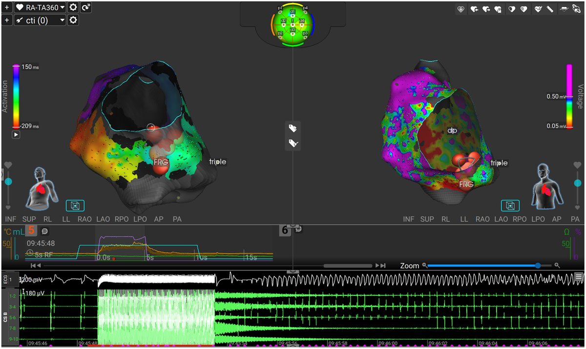 Heart Rhythm Case Reports tweet media